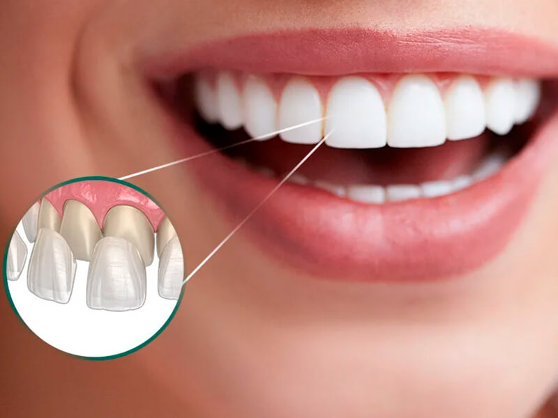 Lentes de contato dentárias