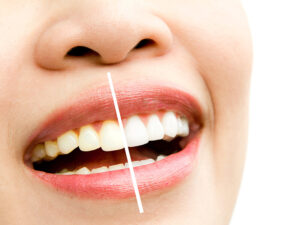 clareamento dental