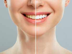 clareamento dental