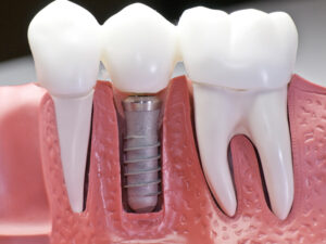 implantes dentários