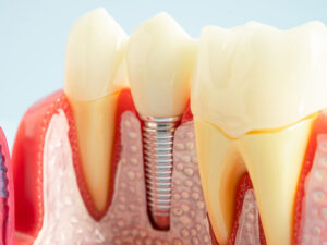 implantes dentários