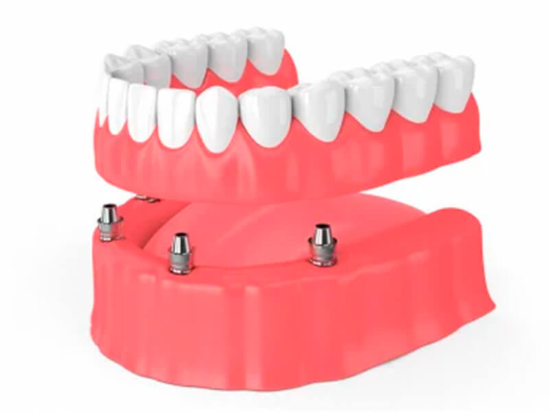 prótese dentária