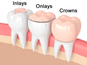 prótese dentária